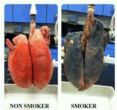Comparing Non Smoker Lungs wiith Smoker
